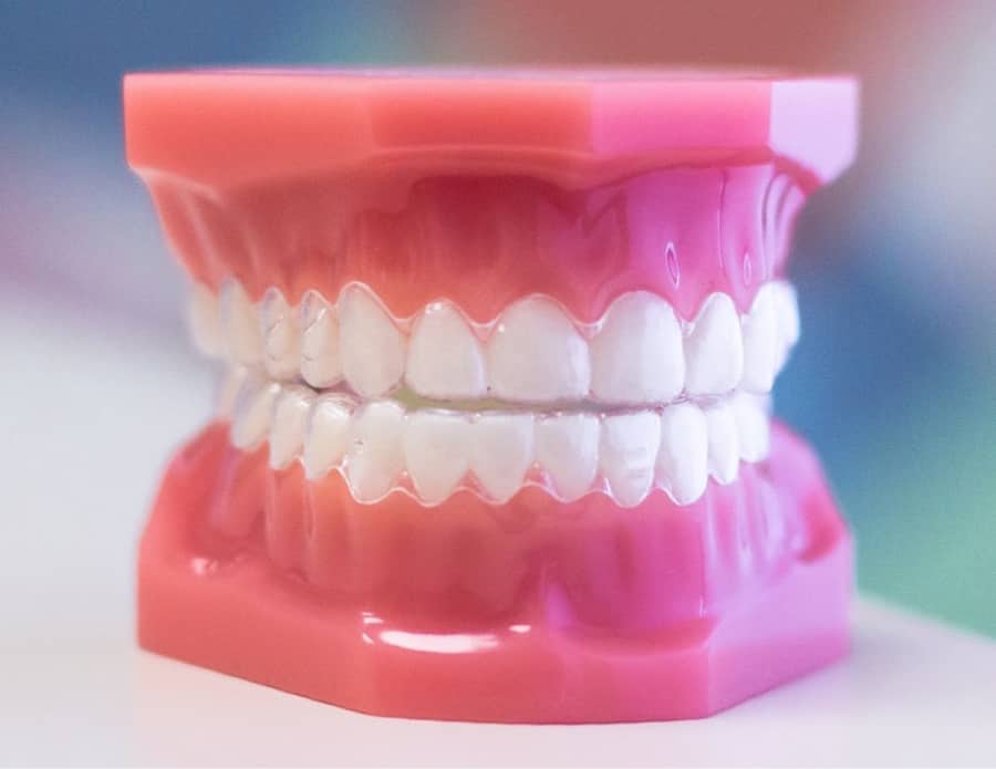 invisalign aligners